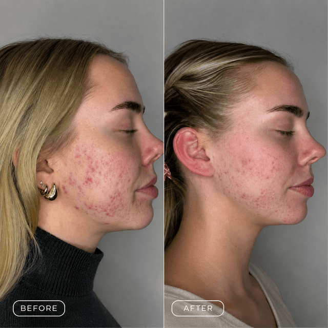 10 Weeks Acne Transformation at Breeze Spa in Myrtle Beach, SC